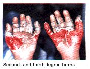 Picture for song '3rd Degree Burn' by artist 'Edvance'