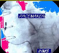 Picture for song 'Pacemaker' by artist 'IHMS'