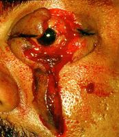 Picture for song 'Incriminating Laceration' by artist 'Paul Carcass'