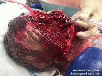 Picture for song 'Suicide Victim' by artist 'Paul Carcass'