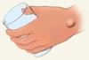 Picture for song 'Ganglion Cyst' by artist 'The Touch of Hutch'
