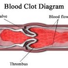 Picture for song 'BLOOD CLOT (Hip-Hop)' by artist 'MB SALONE'